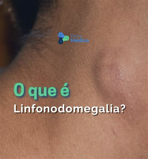 linfonodomegalia o que é
