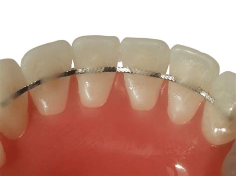 Lingual Bar Retainer Code