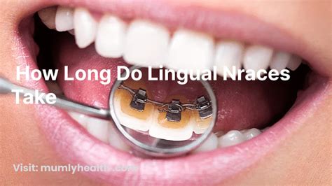 Lingual Braces How Long
