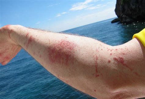 lion's mane jellyfish sting