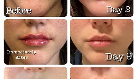 Lip Filler Swelling Stages Photos