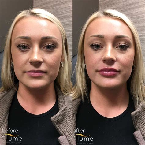 Lip Filler Injections
