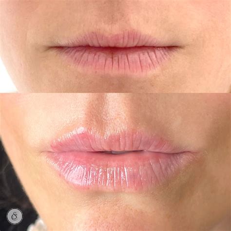 Lip Hydration Filler