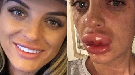 Lip Job Gone Wrong