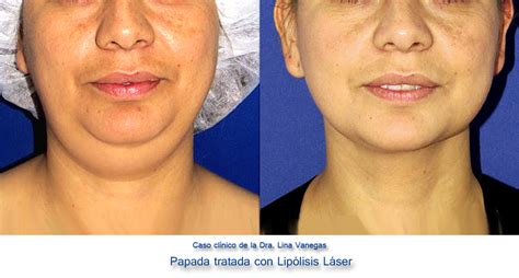 Lipo De Papada Precio