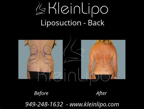 liposuction on back fat