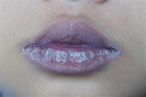 Lips Blue Around Edges
