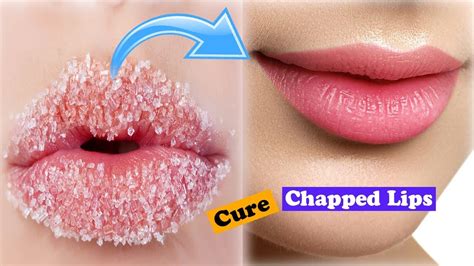 Lips Chapped Everyday