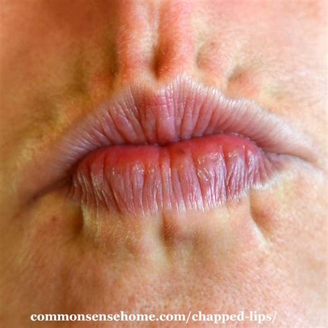 Lips Chapped Lips