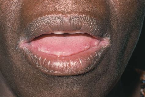 Lips Infection Side Effects