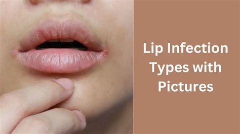 Lips Infection Types