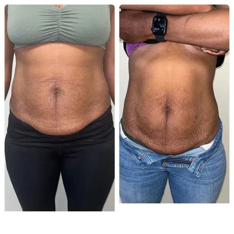 Effective Liquid Lipo Treatment Solutions Uncovered