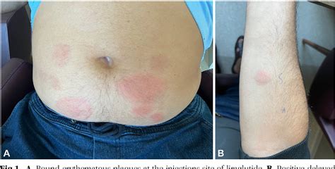 liraglutide injection site reaction