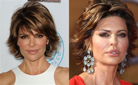 lisa rinna before and after plastic surgery