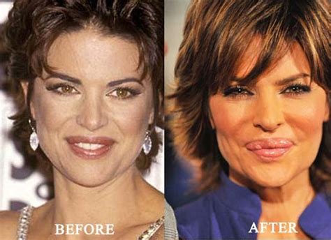 lisa rinna before lip augmentation