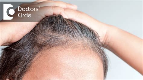 lisinopril hair loss