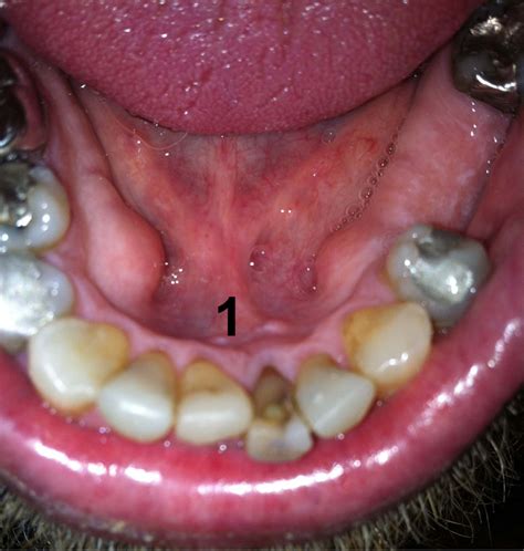 little bumps in the floor of the mouth