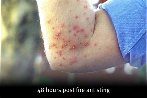 little fire ant bites allergy