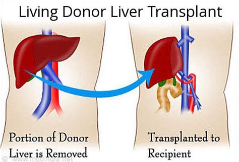 live liver transplant surgery