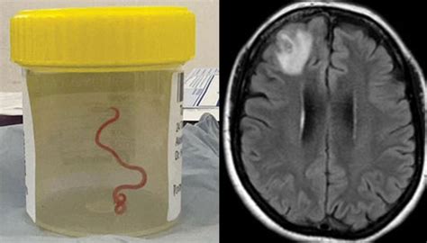 live worm found in brain