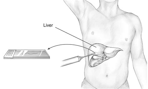 Understanding the Liver Biopsy Procedure: What to Expect During Diagnosis