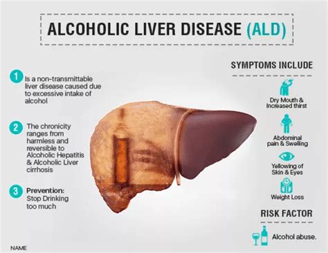 liver disease resulting from alcohol consumption