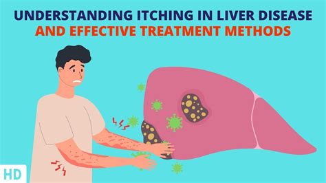Liver Fibrosis Itching