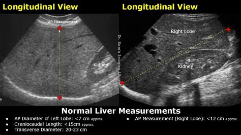 liver measures 18 cm