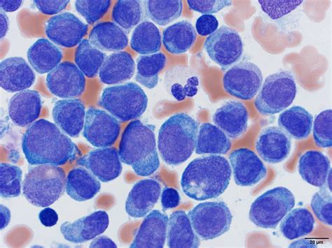 lma leukemia