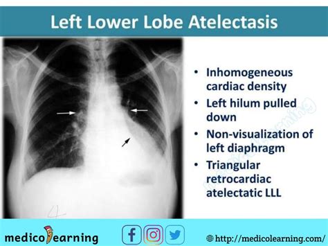 Lobe Atelectasis X Ray