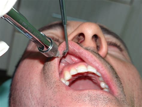 Local Anesthesia Dental Extraction