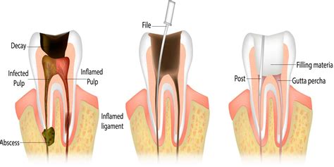 Local Anesthesia for Root Canal