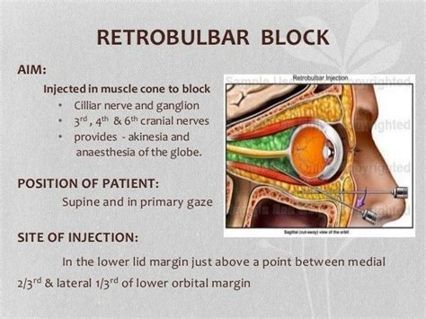 Local Anesthesia Retrobulbar Block