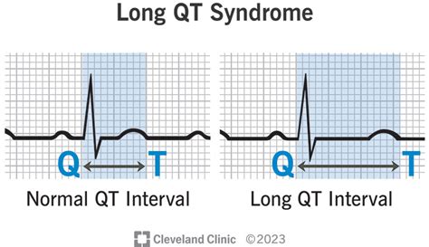 Understanding Long QT Disease: Causes, Symptoms, and Treatments