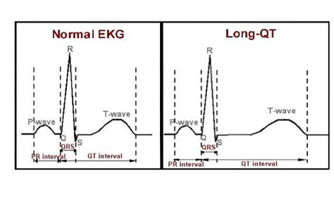 long qt syndrome review