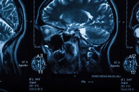 los angeles brain injury research