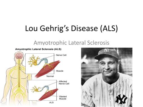 lou gehrig's disease or als