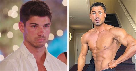 love island before and after surgery