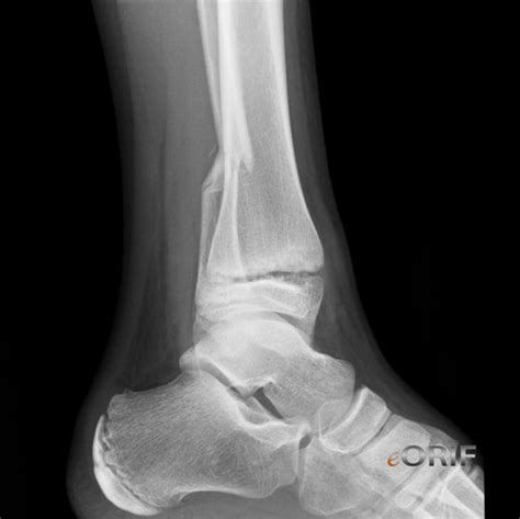lower end tibia icd 10 cm