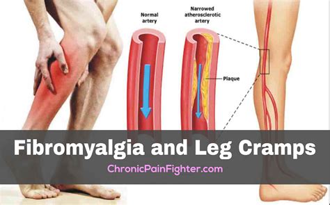 Lower Leg And Toe Cramps