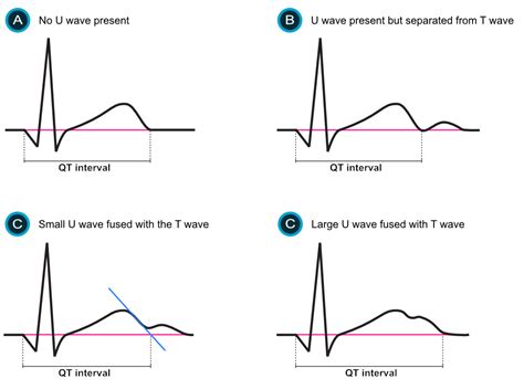 Lower Qt Interval