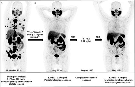 lu-psma-617 prostate cancer