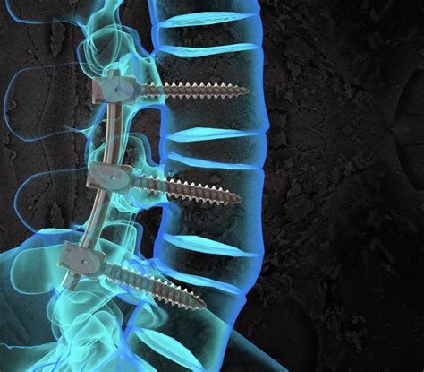 Understanding Lumbar Fusion Surgery: Is It Right for Your Back Pain?