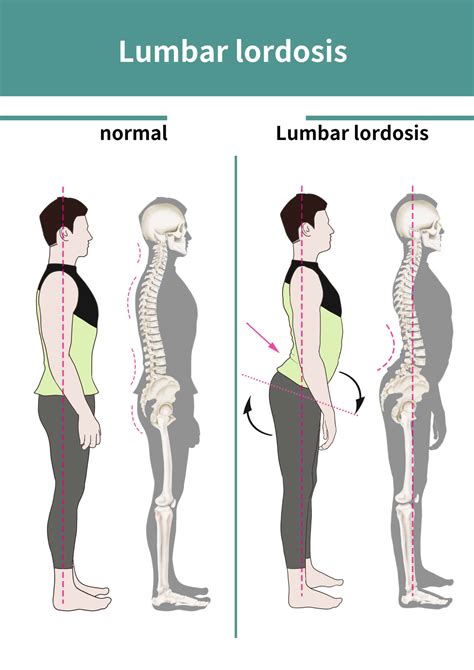 Lumbar Level Definition