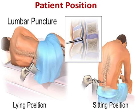 Understanding the Lumbar Puncture Operation: Procedure and Risks