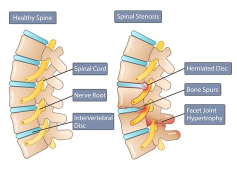 Understanding Lumbar Spinal Stenosis: Causes, Symptoms, and Treatment Options