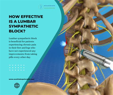 Lumbar Sympathetic Block: Effective Relief for Chronic Pain