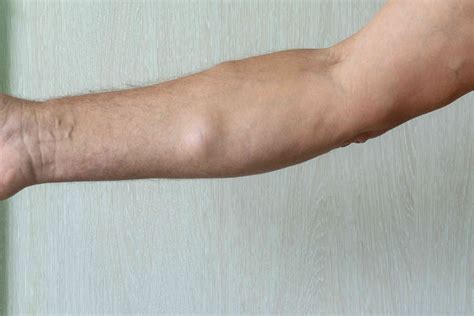 Lump In Your Upper Arm