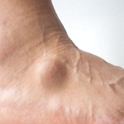 What Causes a Lump on Ankle: Symptoms, Treatment, and When to Seek Medical Attention