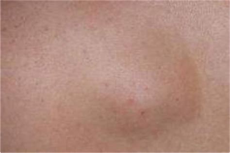 What Causes a Lump on Inside Bum Cheek?